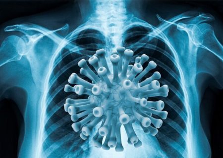 کرونایی ها چگونه درگیری ریوی را تشخیص بدهند؟