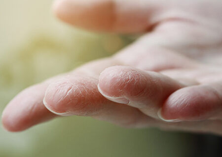 عوامل موثر در خشکی پوست