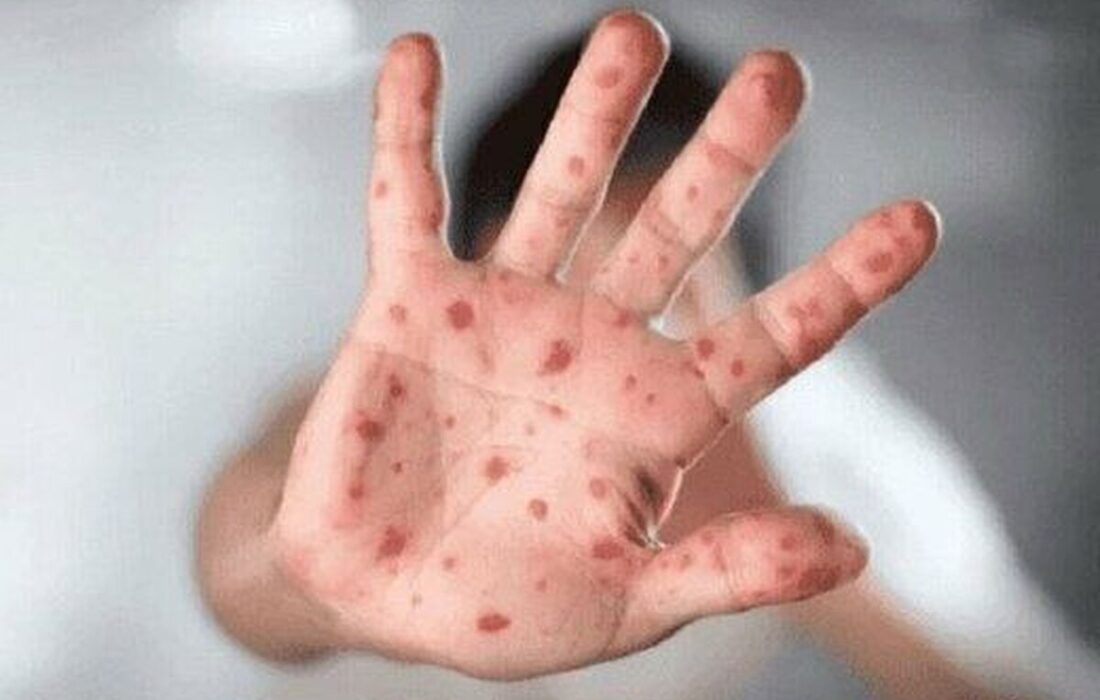 سازمان جهانی بهداشت: «آبله میمونی» را میتوان متوقف کرد