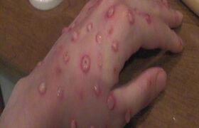 آبله مرغان، بیماری شایع فصل بهار/از دست و دیده بوسی خودداری کنید