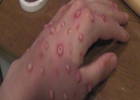 آبله مرغان، بیماری شایع فصل بهار/از دست و دیده بوسی خودداری کنید