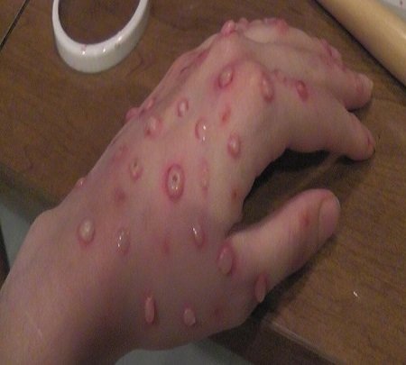 آبله مرغان، بیماری شایع فصل بهار/از دست و دیده بوسی خودداری کنید