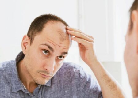 چند باور نادرست درباره ریزش مو