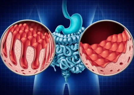 هر آنچه باید درباره بیماری سلیاک بدانیم