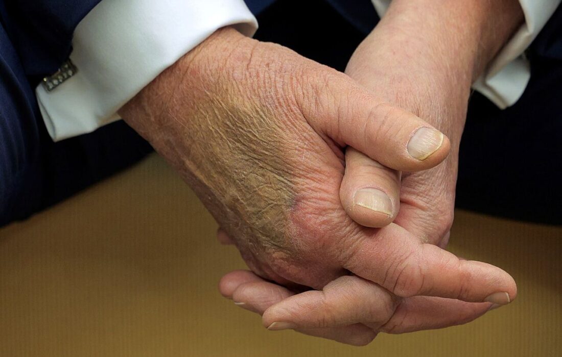 مشاهده دوباره کبودی بر روی دست ترامپ و افزایش گمانه زنی ها در باره سلامتی وی