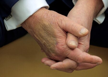 مشاهده دوباره کبودی بر روی دست ترامپ و افزایش گمانه زنی ها در باره سلامتی وی