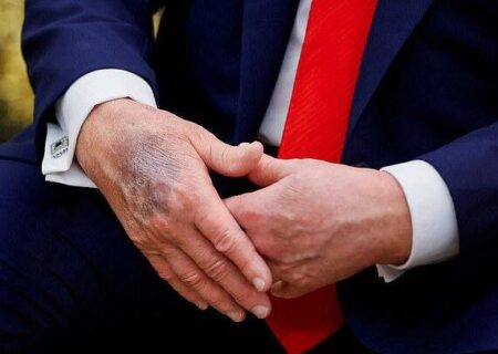 ترامپ از چه بیماری‌هایی رنج می‌برد؟