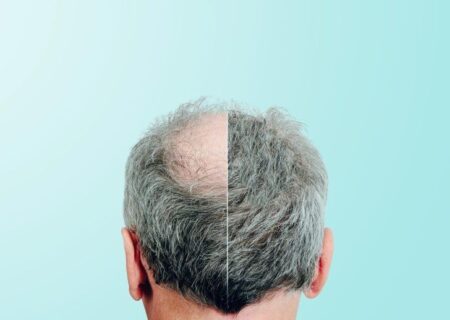 درمان طاسی سر با یک شیرین‌کننده طبیعی