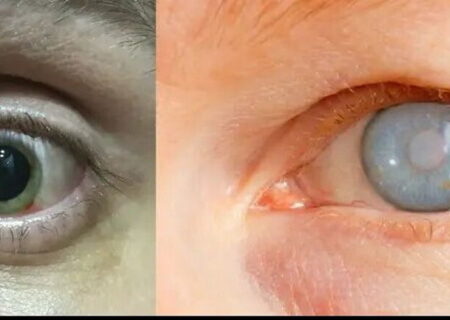 هزاران نفر با خطر نابینایی قرار دارند