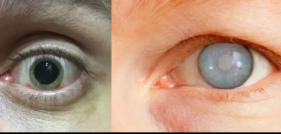 هزاران نفر با خطر نابینایی قرار دارند