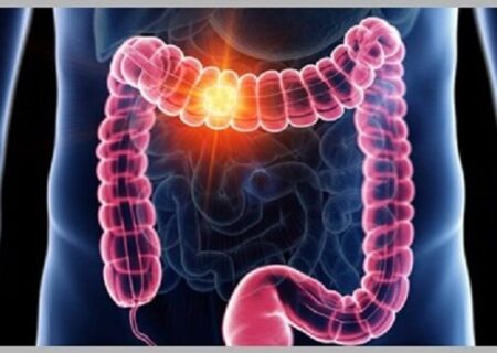 چرایی بروز سرطان روده بزرگ و علائم ابتلا به آن