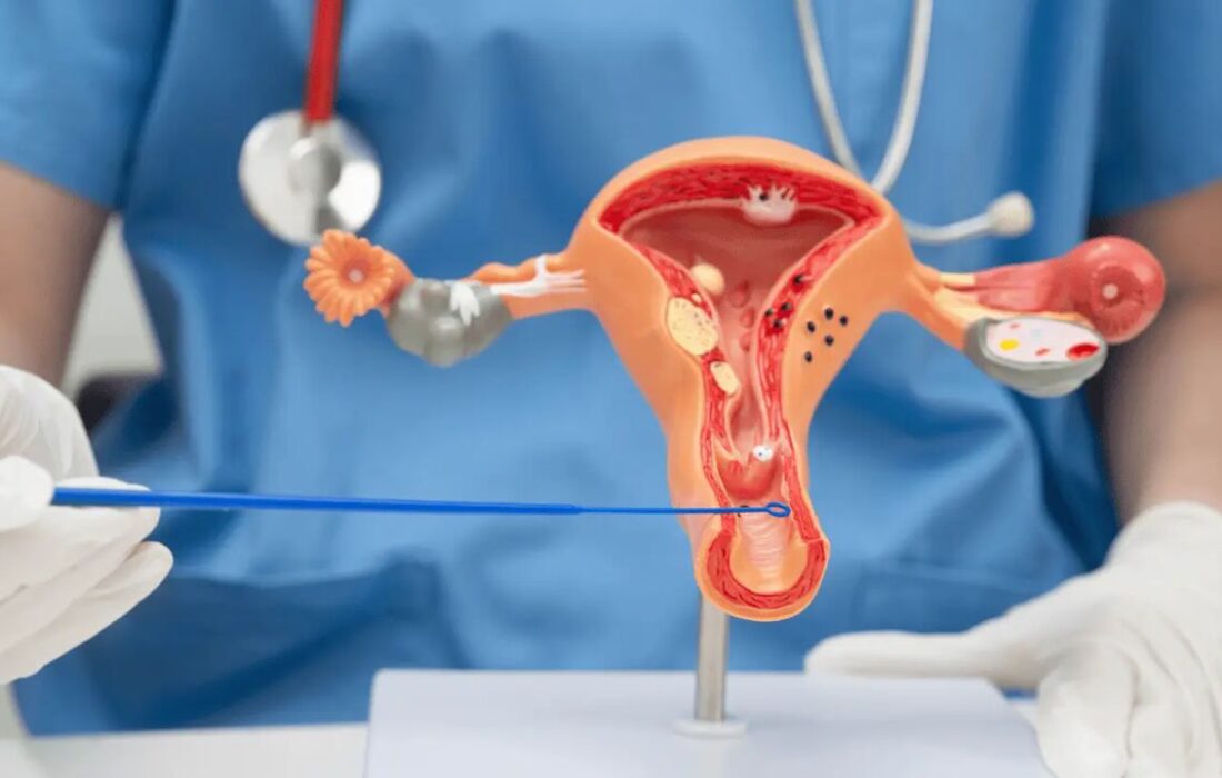 ابتلا به سرطان دهانه رحم از نوجوانی آغاز می‌شود